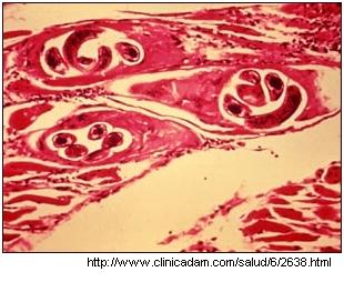 tejido infectado por quistes de Trichinella